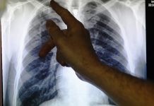 Can drug-resistant TB get cured?