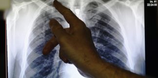 Can drug-resistant TB get cured?