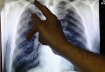 There is evidence to suggest that TB itself is a risk factor for developing diabetes.