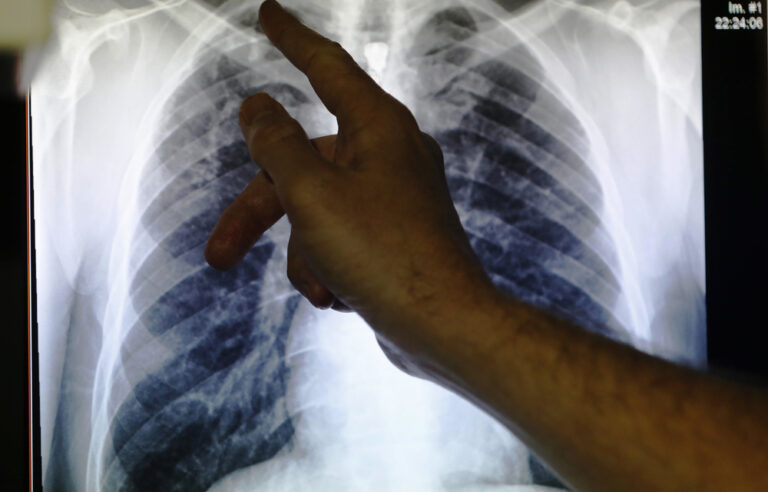 [LISTEN] Can drug-resistant TB get cured?