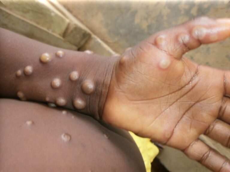 [LISTEN] Most people with mpox in SA have HIV, but are not on treatment 